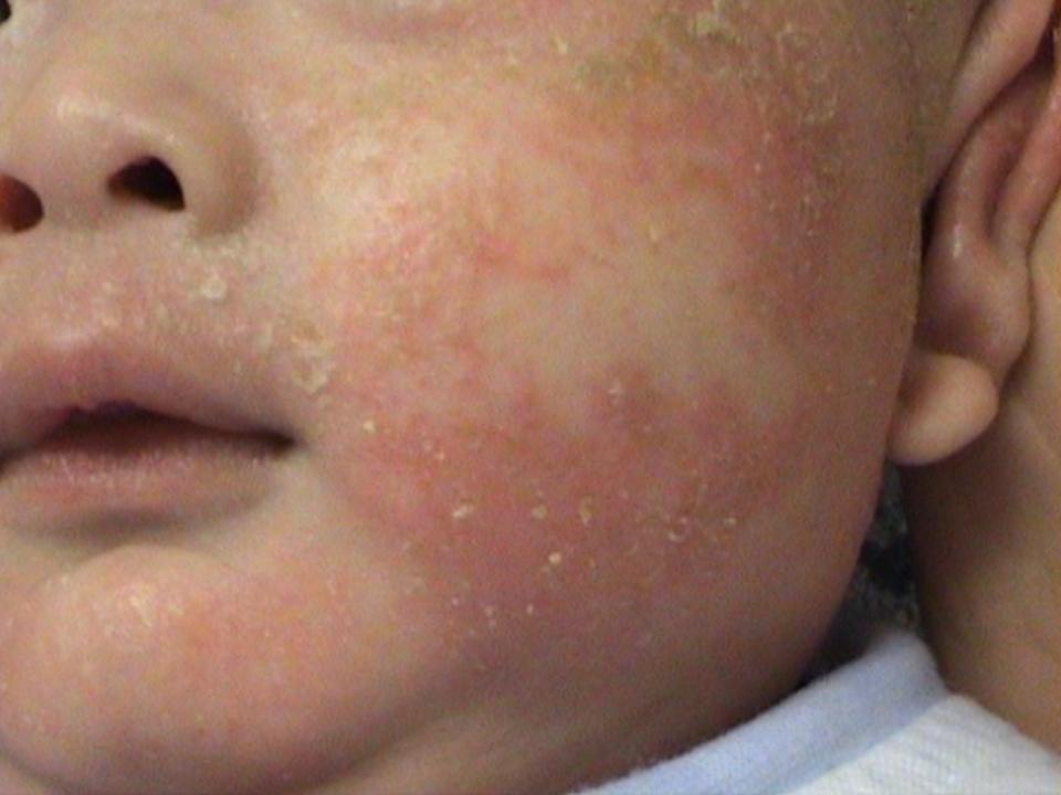 Showing infantile eczema over the back of knee of a child 嬰兒濕疹